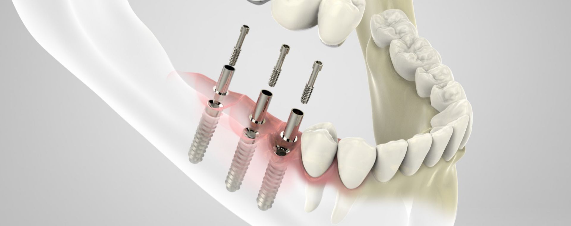 Clinica Odontoiatrica Mancini - implantologia