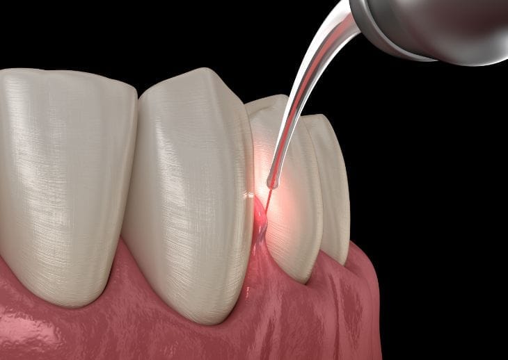 Clinica-Odontoiatrica-Mancini - laser