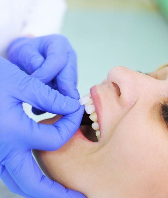 Faccette dentali a Milano