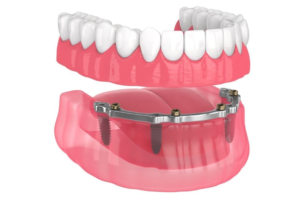 Clinica Mancini - Overdenture