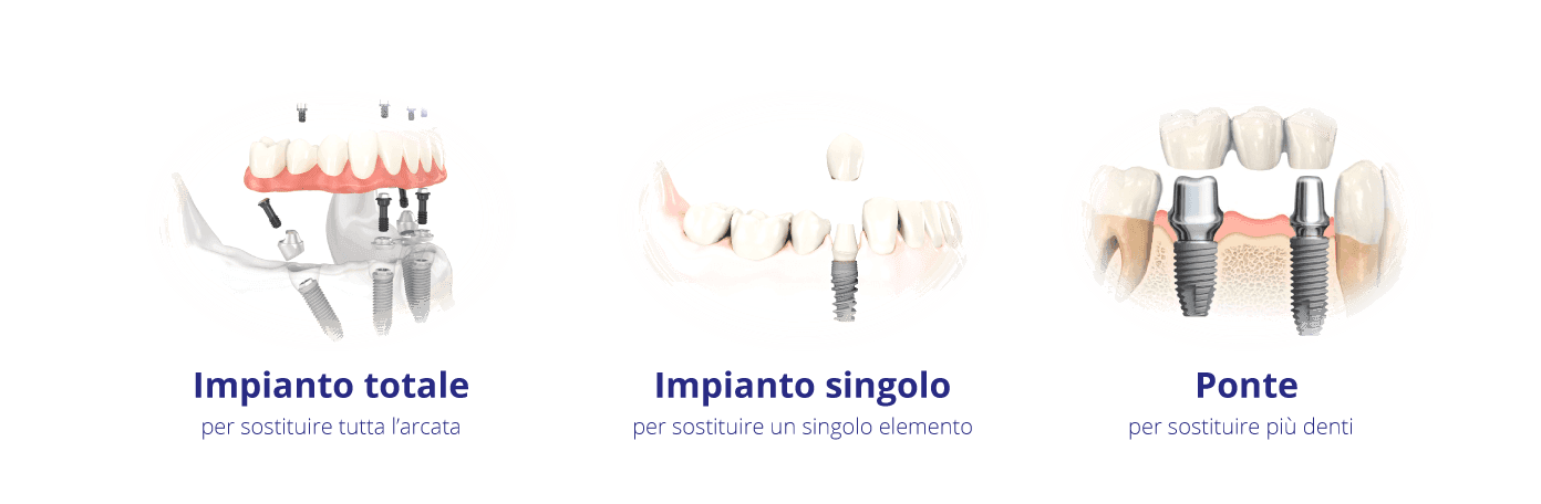 Nuove-tecnologie-in-implantologia-dentale