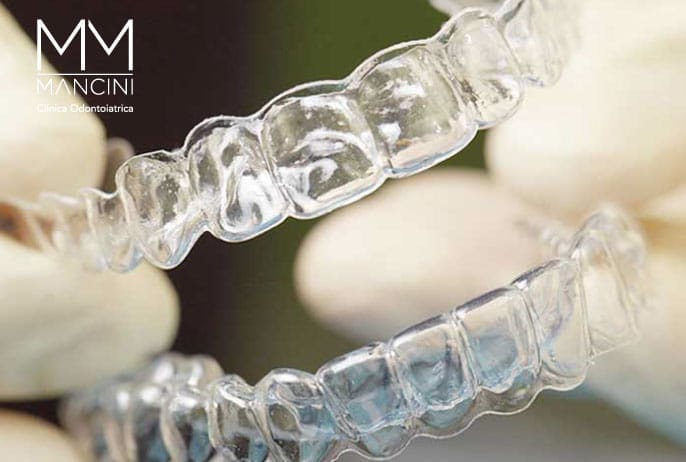 apparecchio invisalign|apparecchio invisalign|apparecchio invisalign|apparecchio invisalign