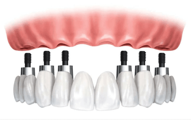 Toronto bridge dentale