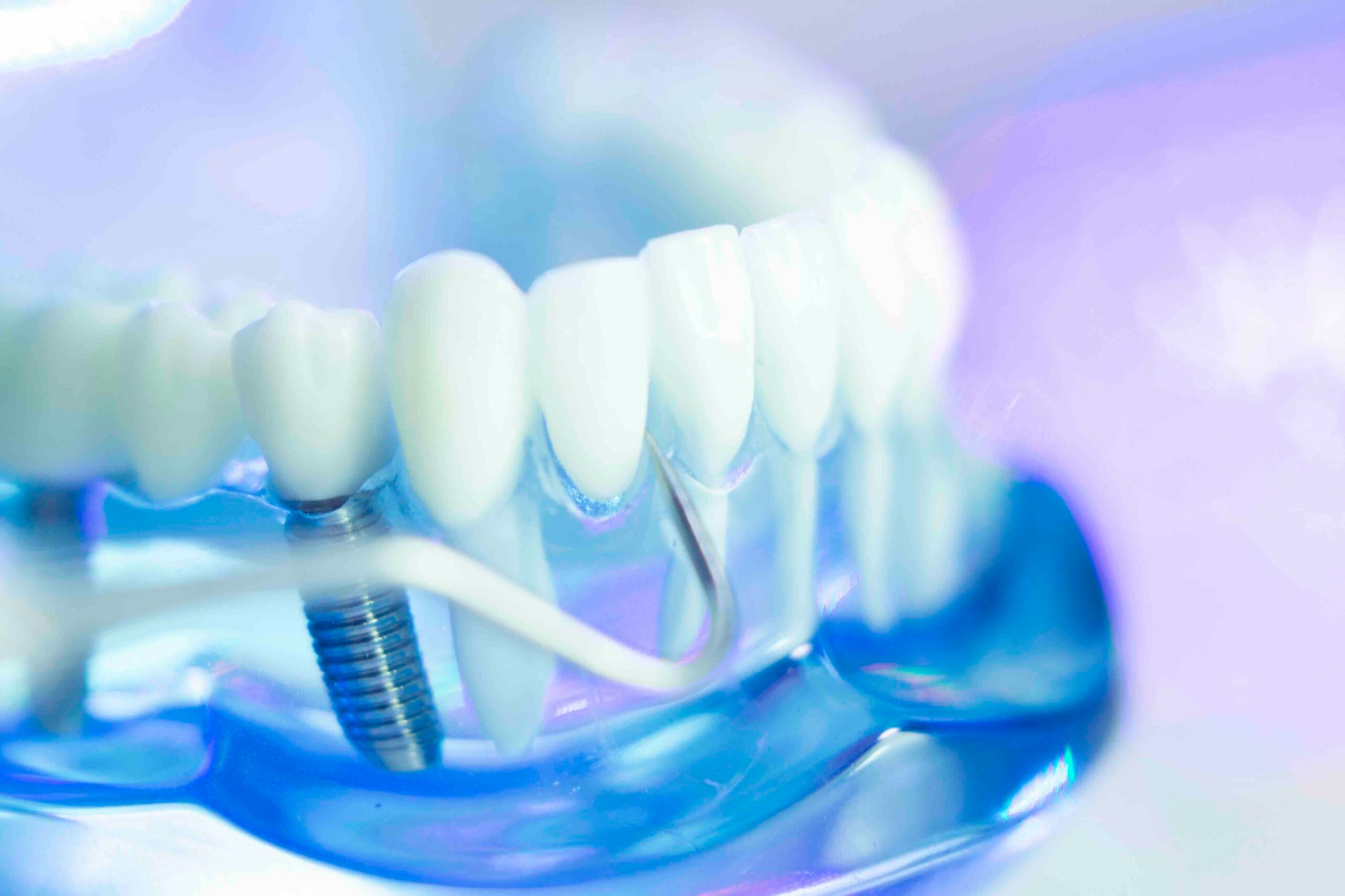 Impianto dentale a Milano
