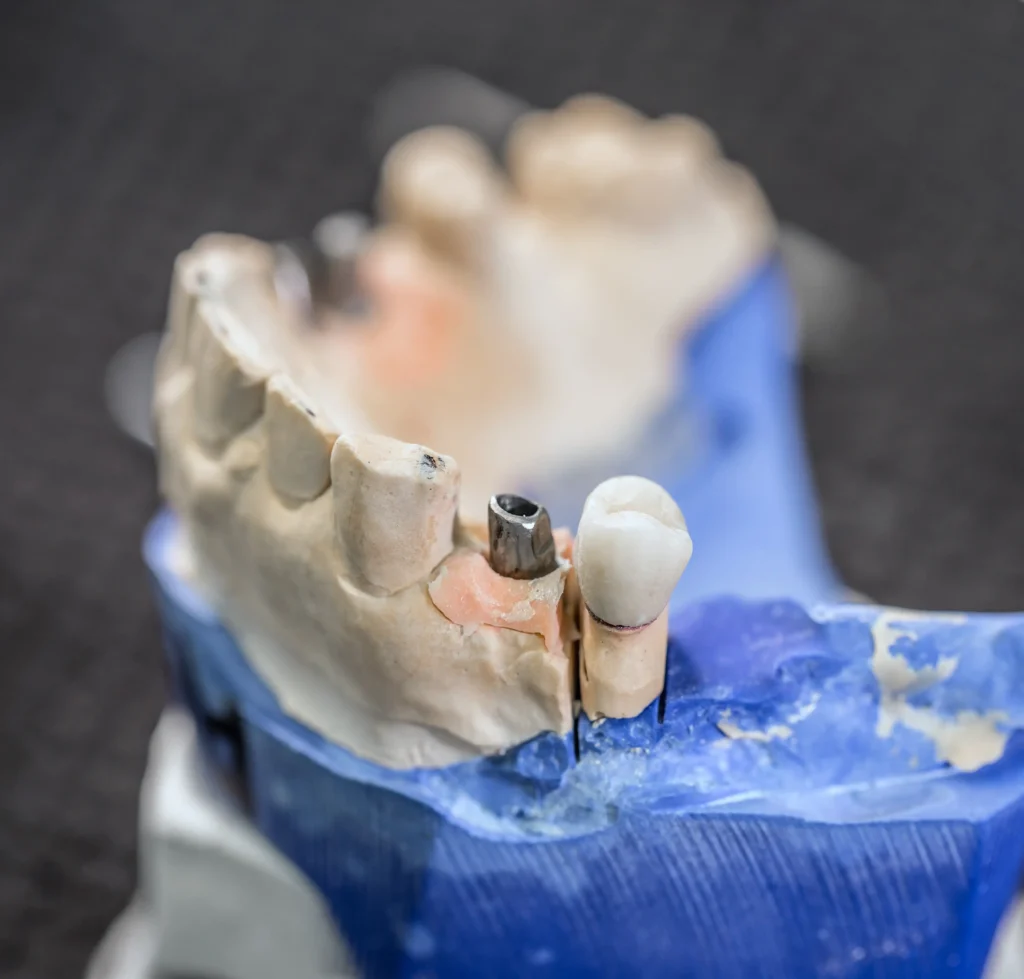 impianti dentali per tutta la vita
