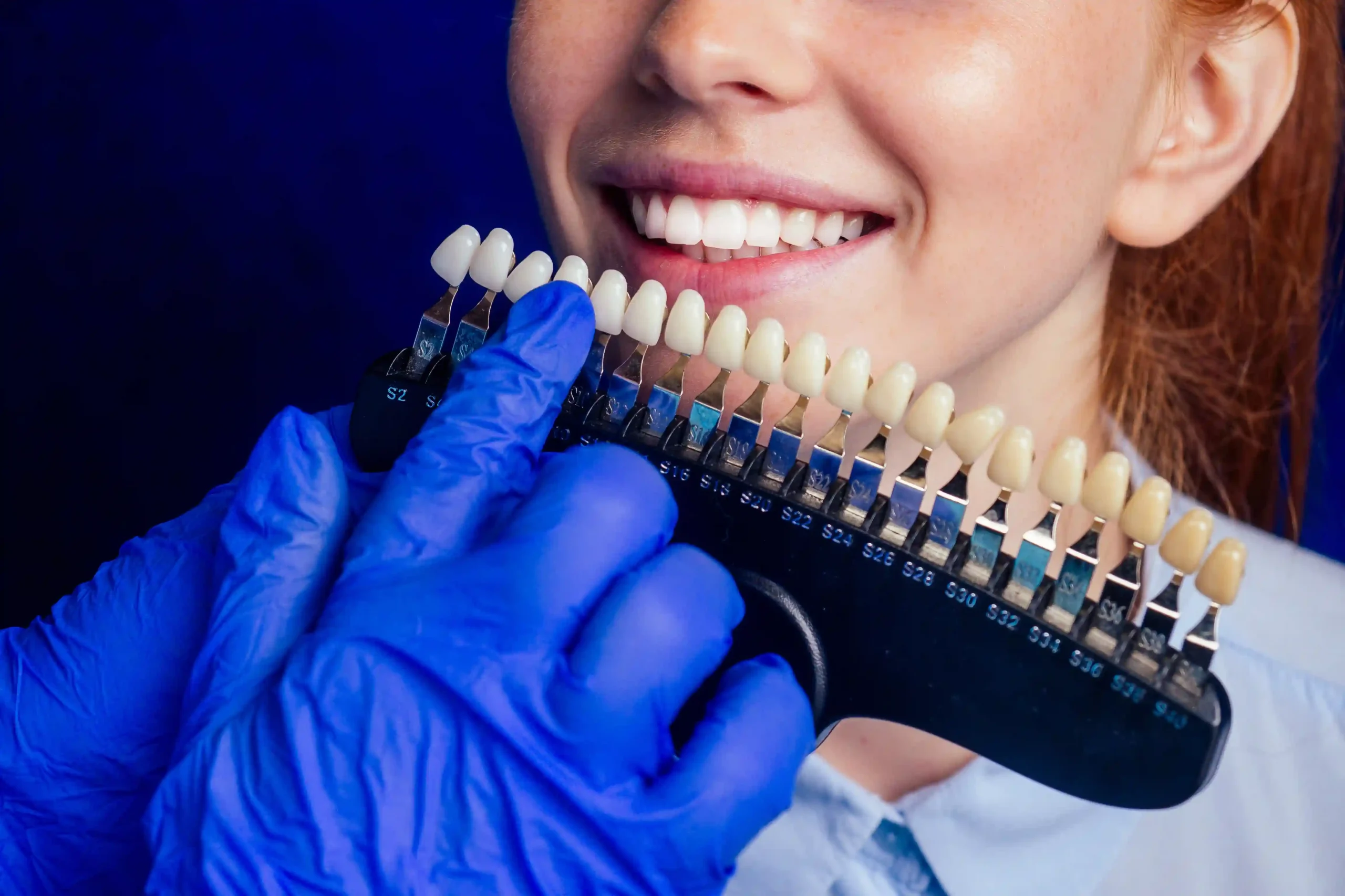 Faccette dentali e macchie